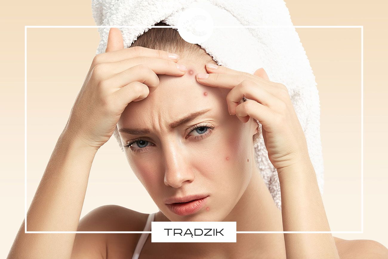 Trądzik młodzieńczy: Jak wyleczyć go naturalnymi i innymi sposobami?