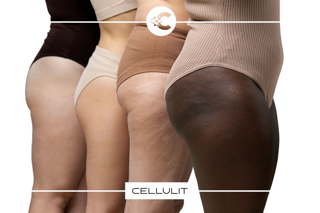 Czym jest Cellulit?