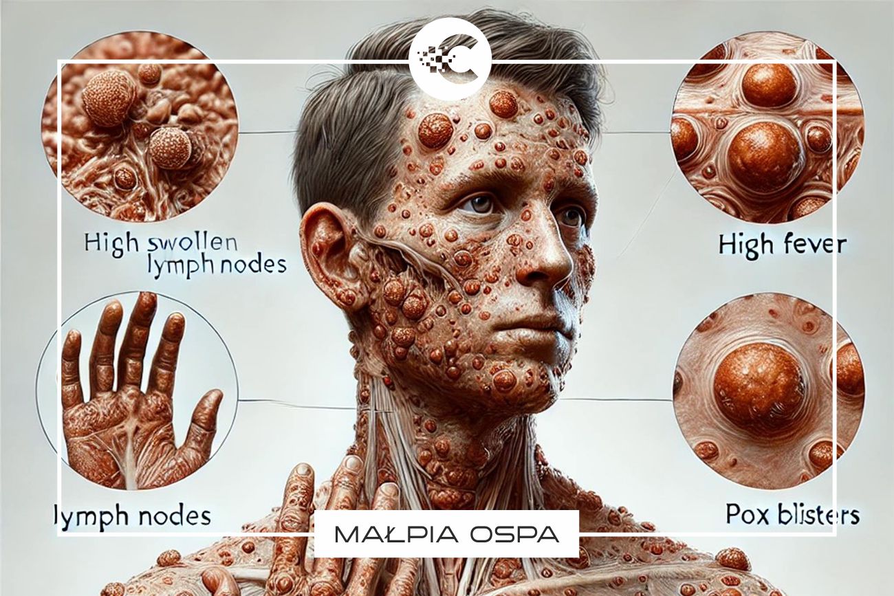 Małpia ospa: najnowsze informacje, objawy i leczenie.